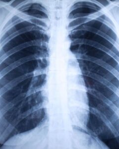 X-RAY